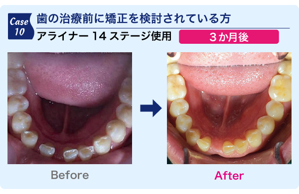 歯の治療前に矯正を検討されている方