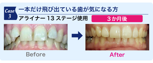 一本だけ飛び出している歯が気になる方