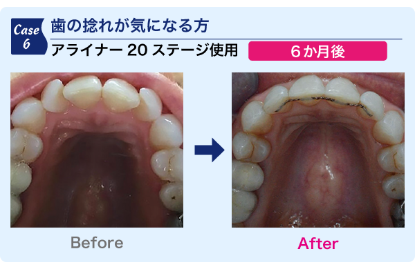 歯のねじれが気になる方