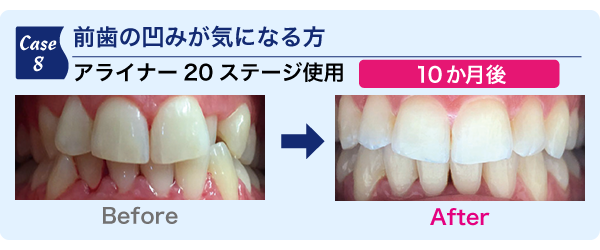 前歯の凹みが気になる方